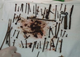 В желудке бабули из Бурятии хирурги нашли «склад» металлических предметов